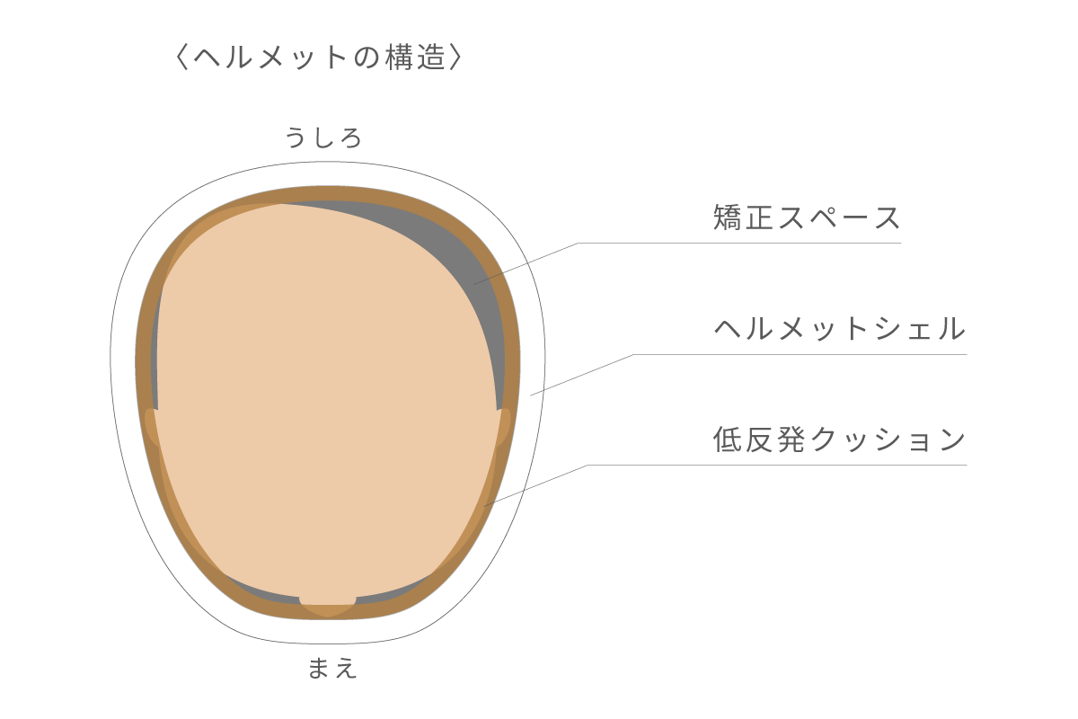 ヘルメットの矯正原理と頭蓋成長スペースの図解